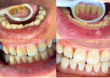 ThS.BS. Nguyễn Quang Tiến: Cao răng gây hệ luỵ gì, cách phòng tránh