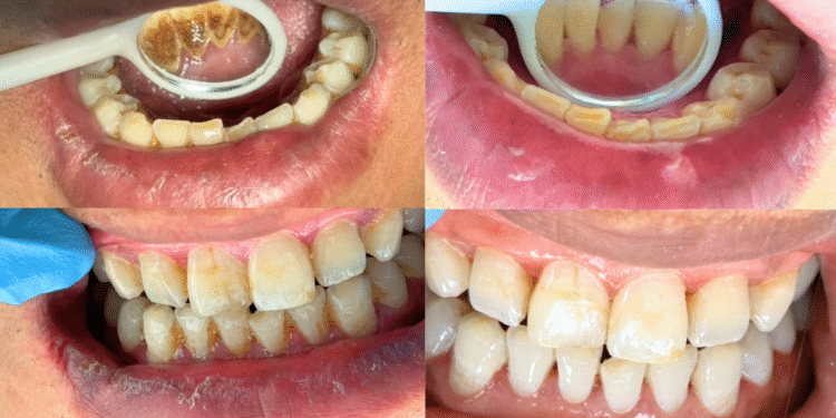 ThS.BS. Nguyễn Quang Tiến: Cao răng gây hệ luỵ gì, cách phòng tránh