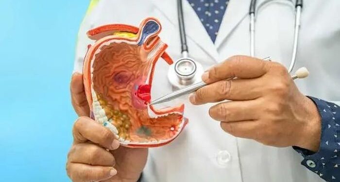 Nên và không nên ăn gì khi bị loét dạ dày?