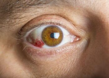 Viêm củng mạc có nguy hiểm không?