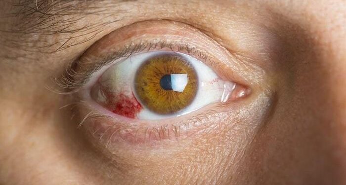 Viêm củng mạc có nguy hiểm không?