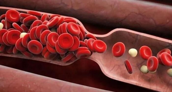 Phân tử tí hon giúp bạn tránh xa nhồi máu cơ tim